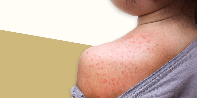 A photo of a child's shoulder showing measles. 